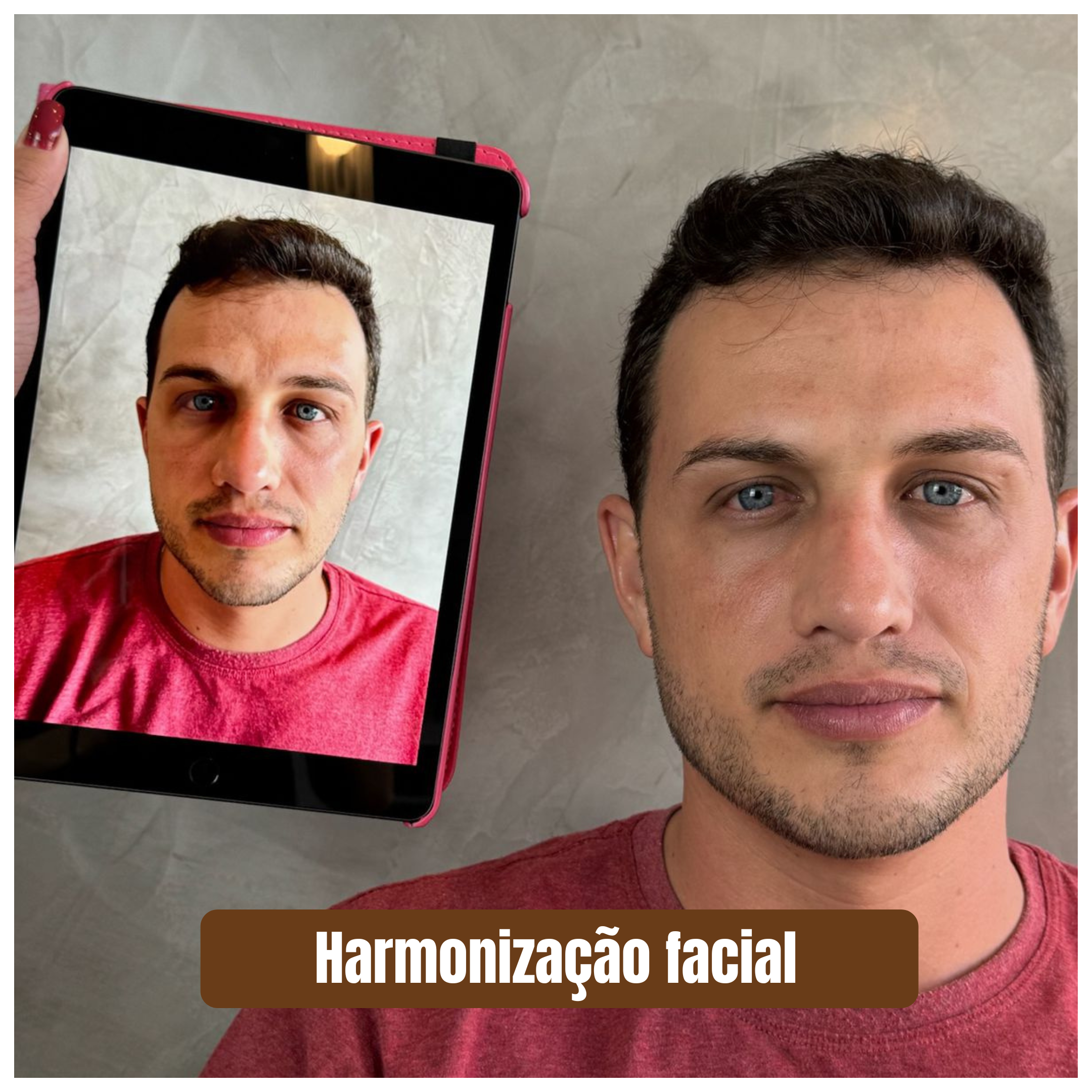 Harmonização facial 1 (2)