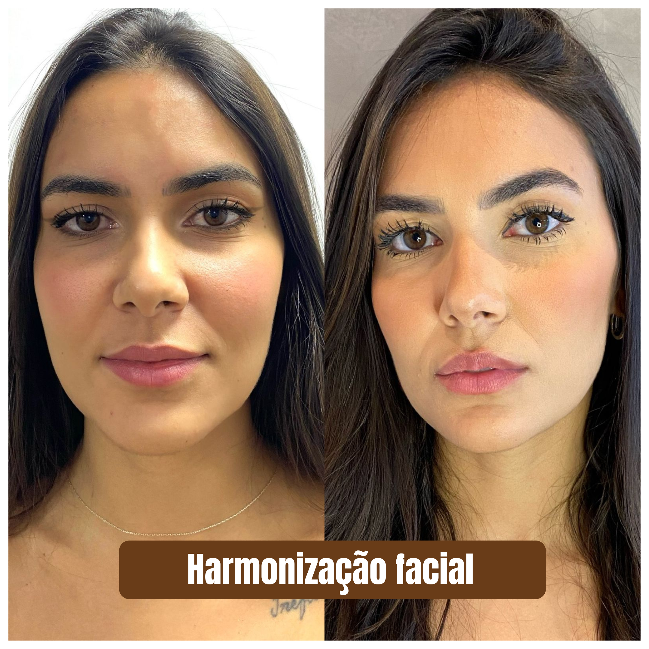 Harmonização facial 1