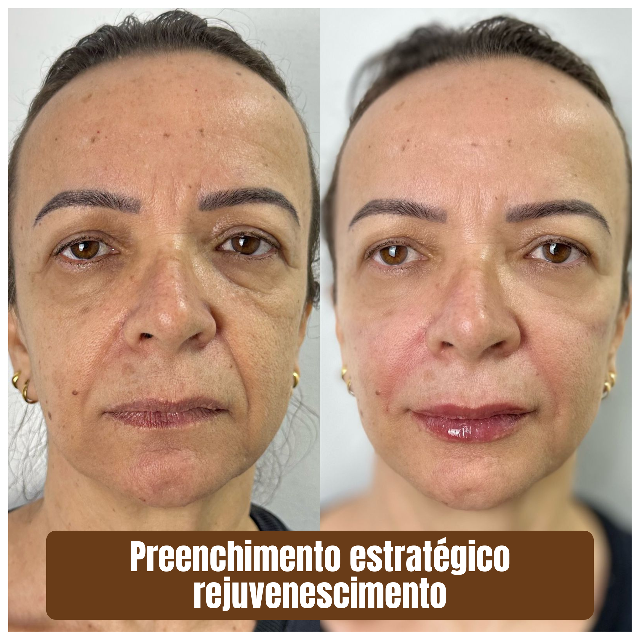Preenchimento estratégico rejuvenescimento 1