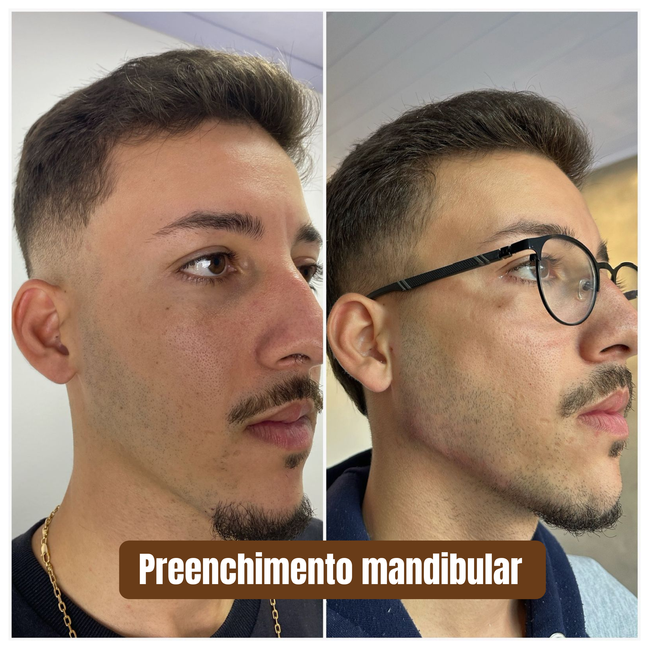 Preenchimento mandibular 1