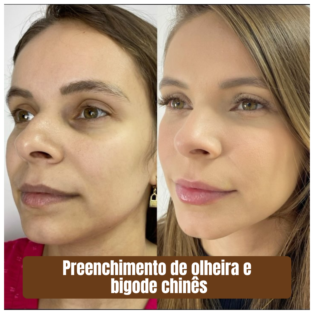 Preenchimento estratégico rejuvenescimento 1 (2)