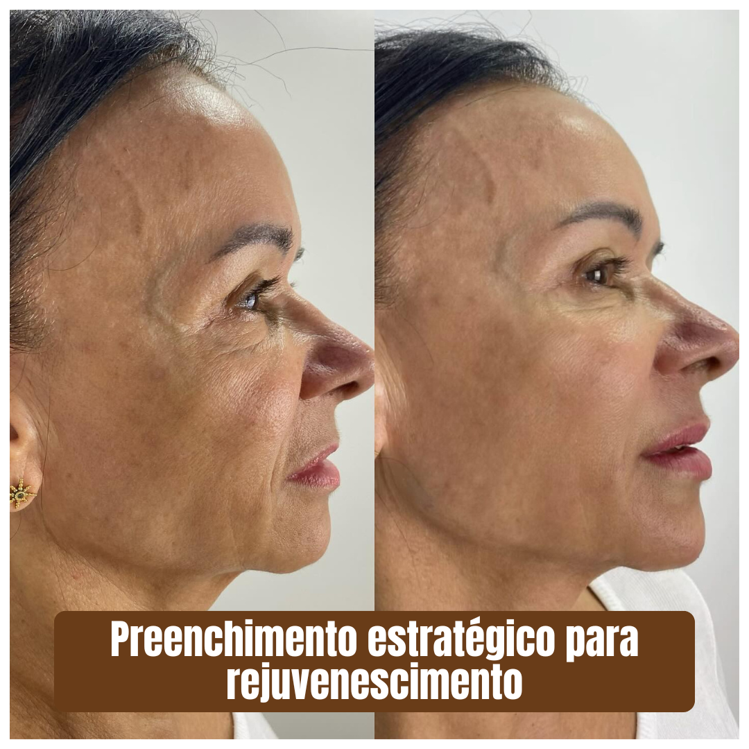 Preenchimento estratégico rejuvenescimento 1 (3)