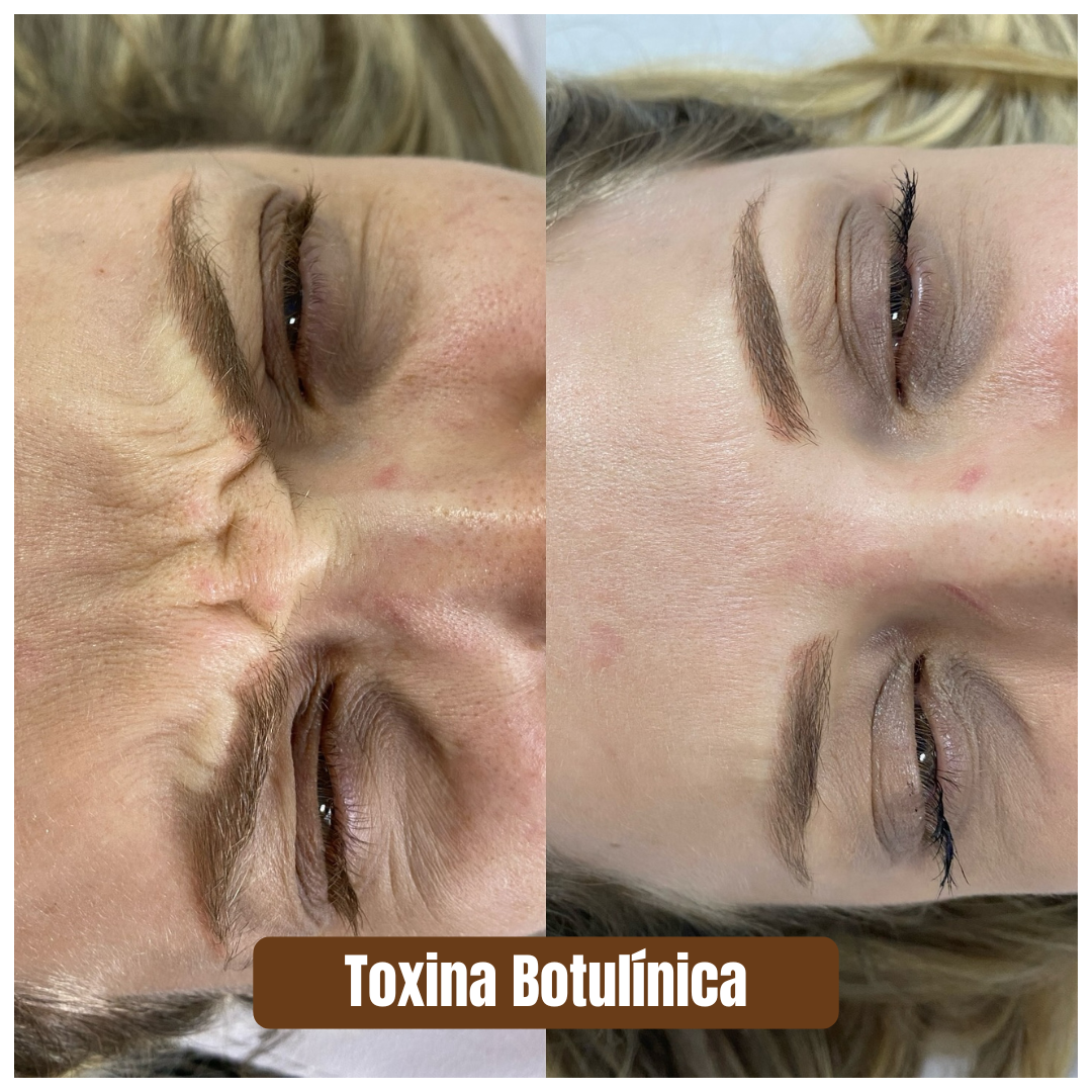 Preenchimento estratégico rejuvenescimento 1 (4)