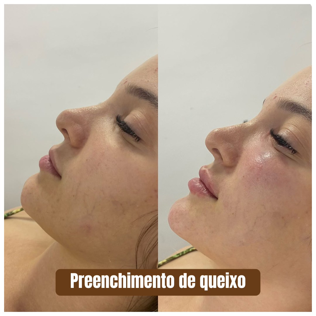 Preenchimento estratégico rejuvenescimento 1 (5)