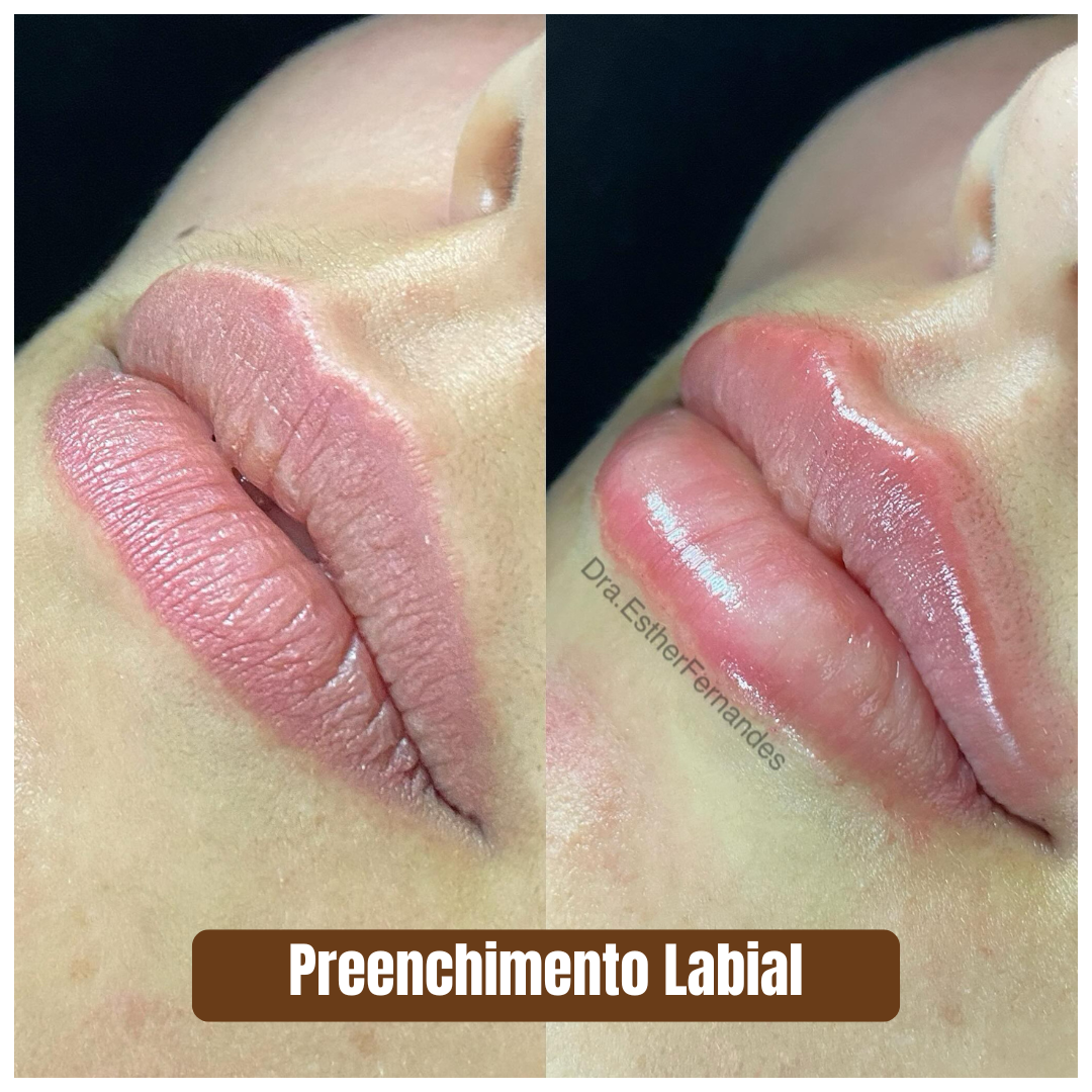 Preenchimento estratégico rejuvenescimento 1 (6)