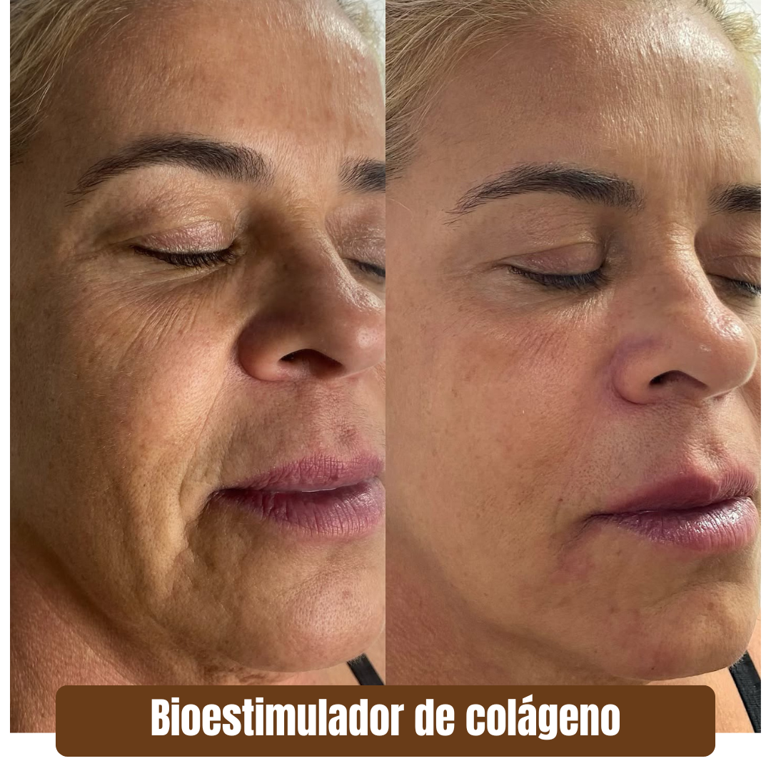 Preenchimento estratégico rejuvenescimento 1