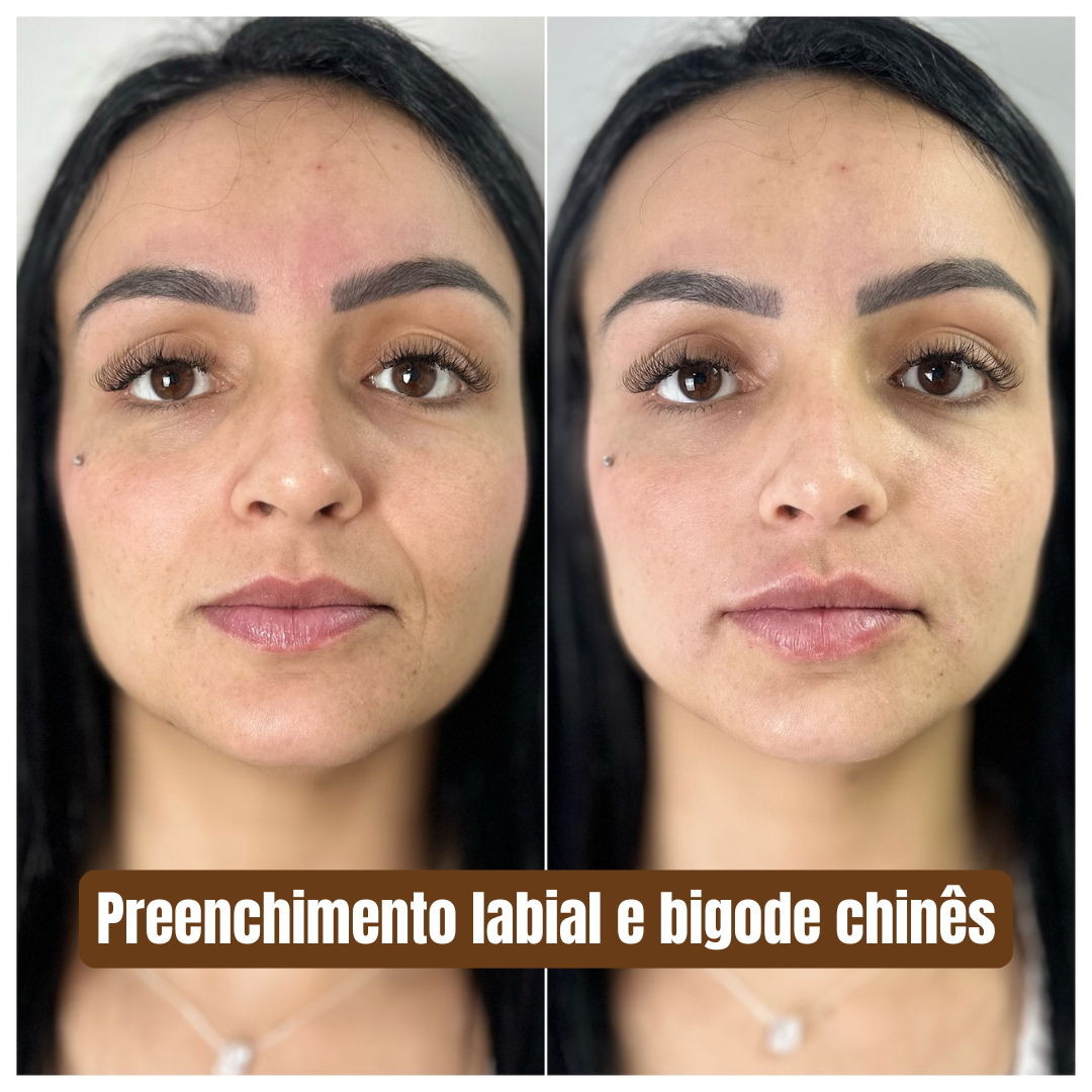 Preenchimento labial e bigode chinês 1