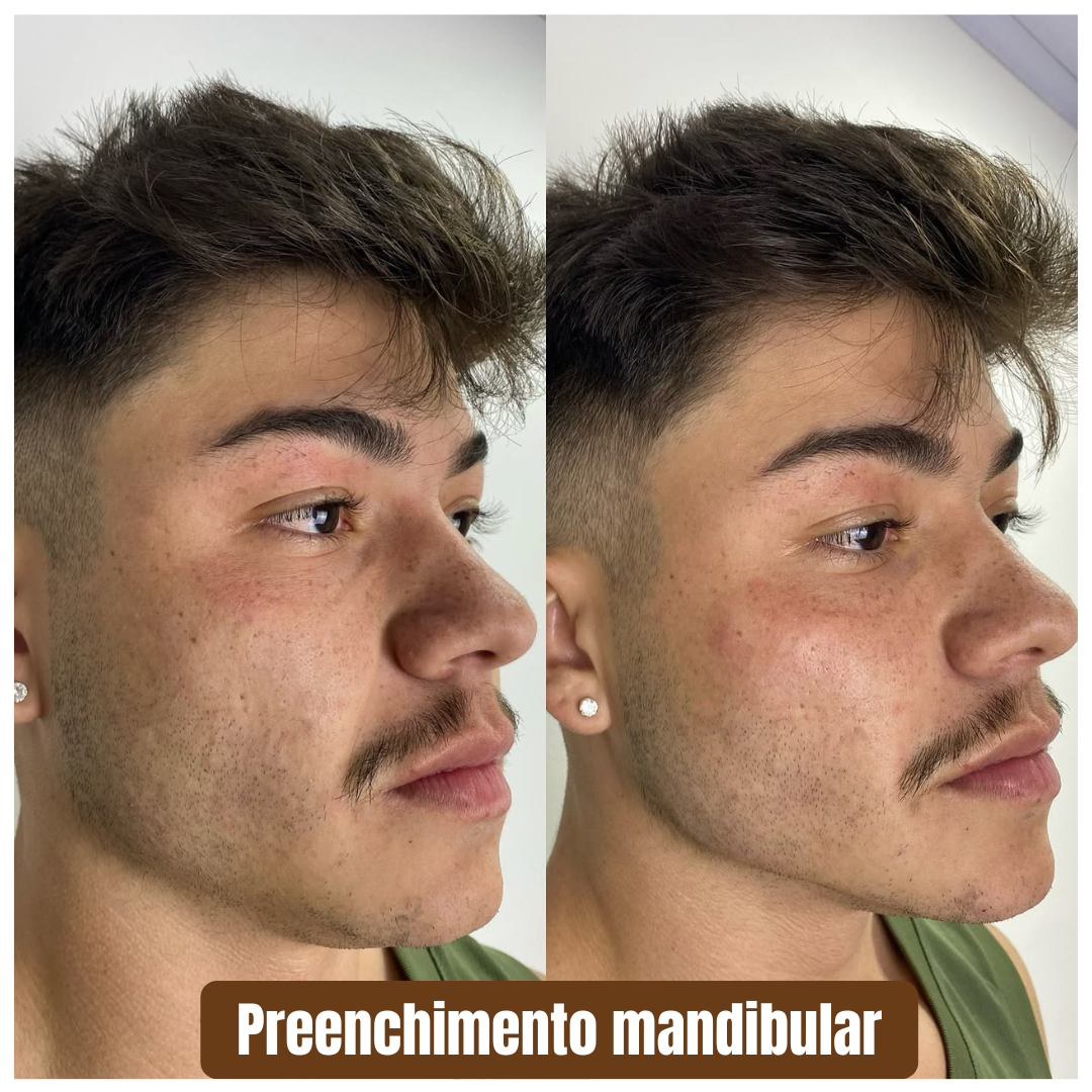 Preenchimento mandibular 1