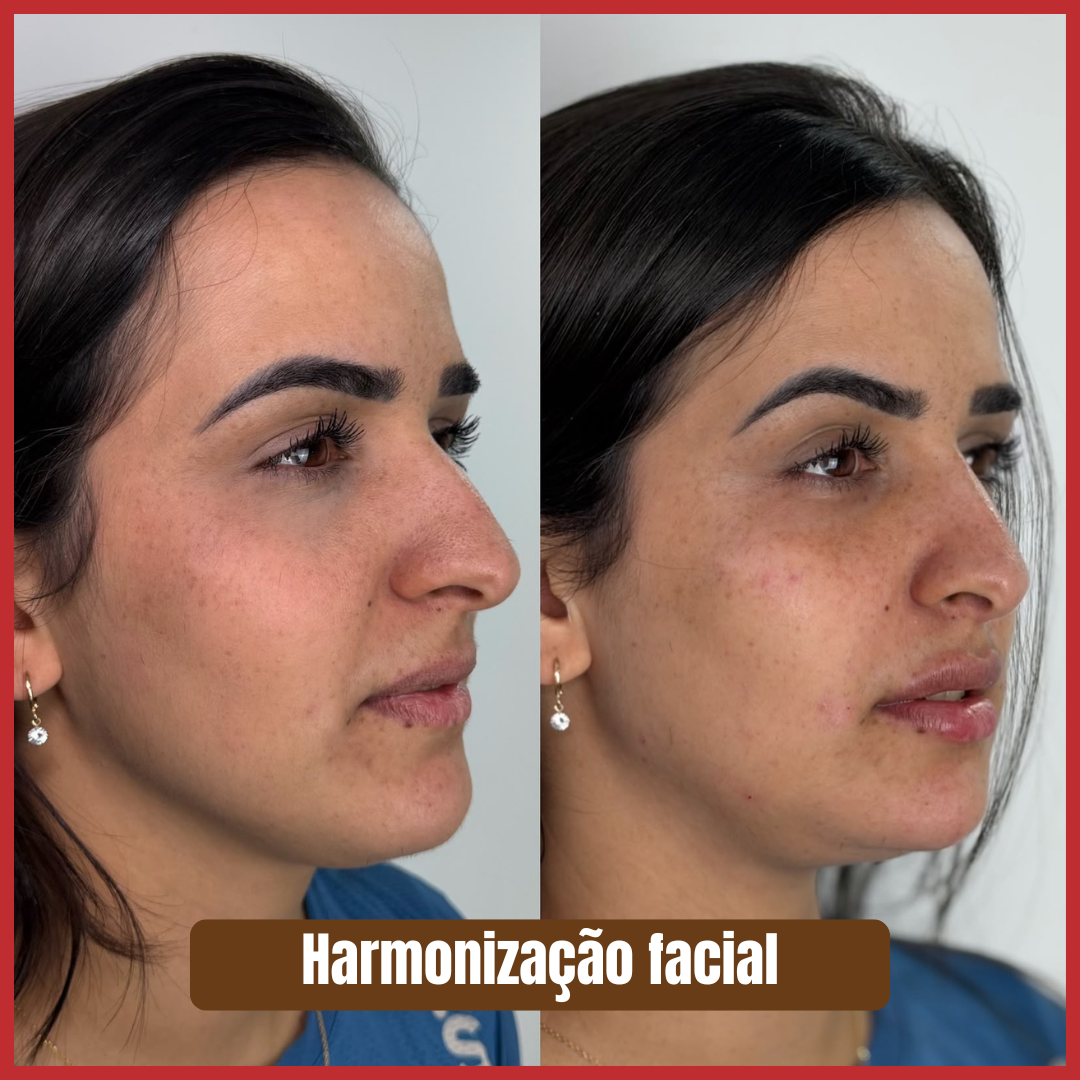 Preenchimento estratégico rejuvenescimento 1